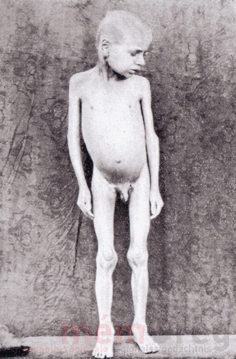 Rachitischer Knabe, Wien 1919