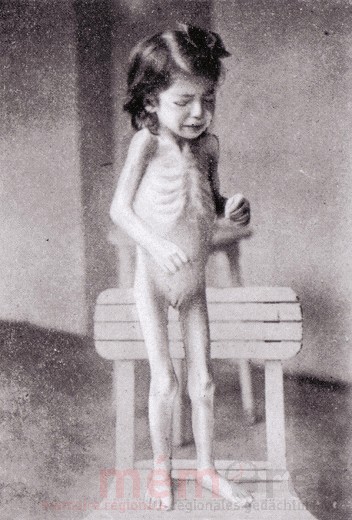 Mädchen mit Tuberkulose, Wien 1919